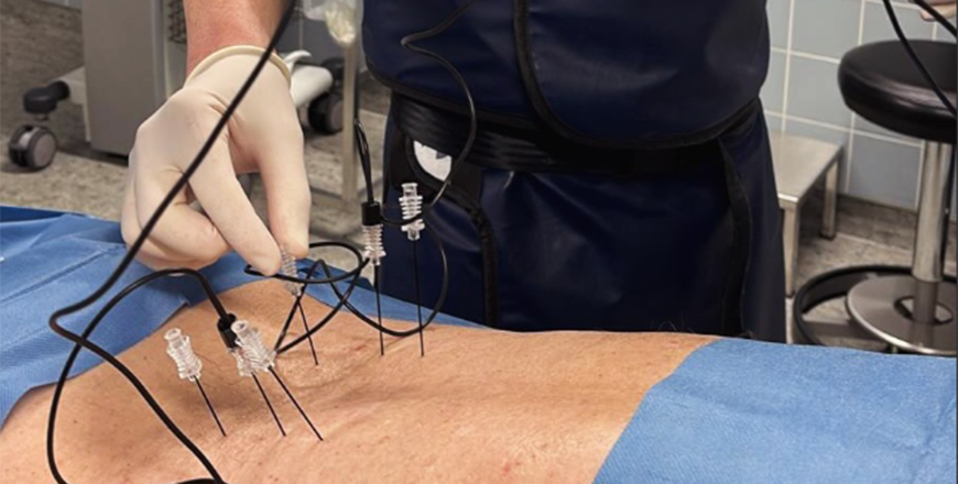 Radiofrequenz-Denervation bei Orthopädie Rickert in Seligenstadt